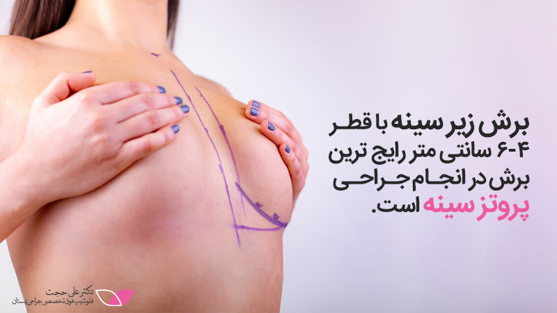 انجام جراحی پروتز سینه