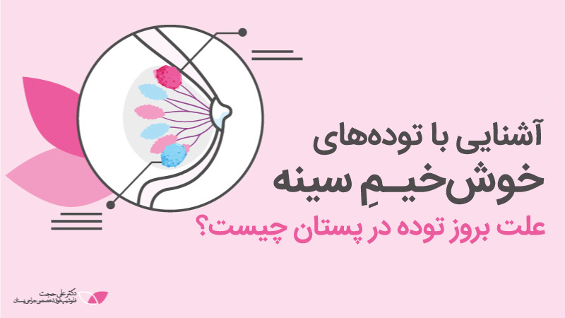 توده های خوش خیم سینه | توده چیست