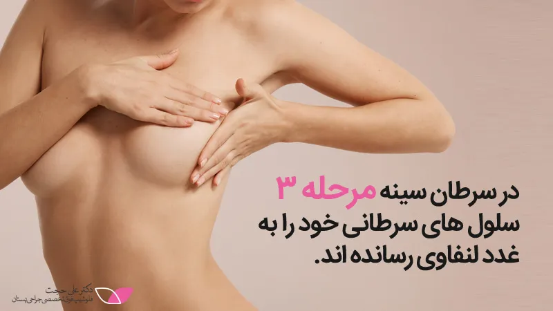 سرطان سینه مرحله ۳