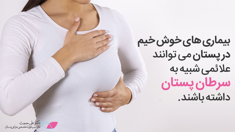 علائم سرطان سینه خوش خیم