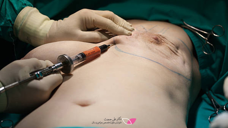ماستکتومی رادیکال چیست