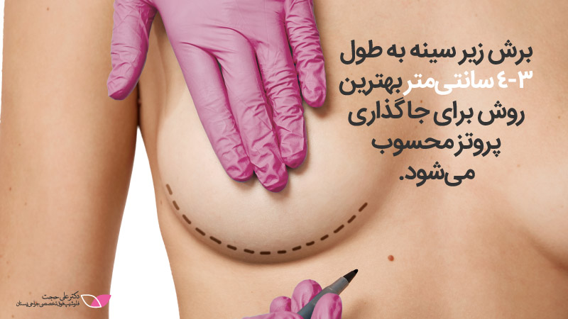 پروتز سینه | جراحی پروتز سینه