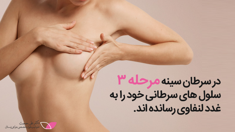سرطان سینه مرحله۳