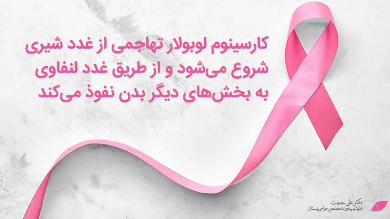 شروع کارسینوم لوبولار تهاجمی شروع کارسینوم لوبولار تهاجمی