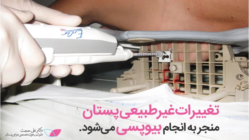 علت تجویز بیوپسی پستان علت تجویز بیوپسی پستان