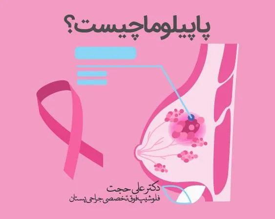 پاپیلوما سینه