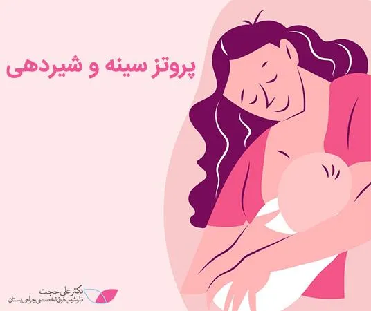 پروتز سینه و شیردهی