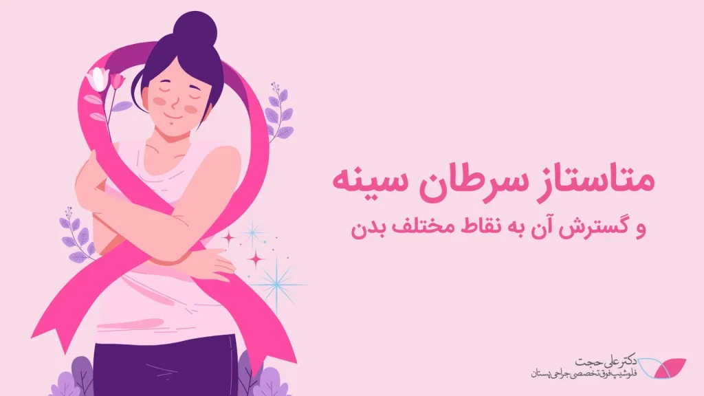 متاستاز سرطان پستان