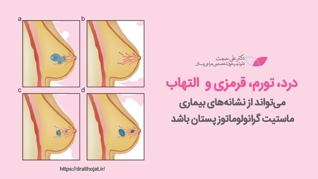 تعریف ماستیت گرانولوماتوز