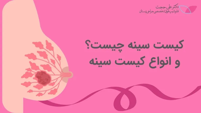 کیست پستان کیست پستان