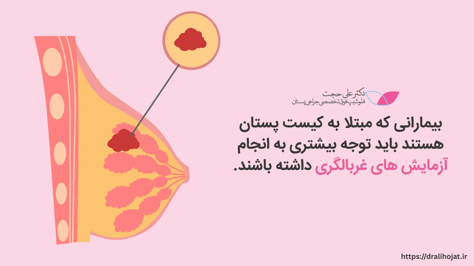 چه زمانی برای کیست سینه باید به پزشک مراجعه کنیم؟
