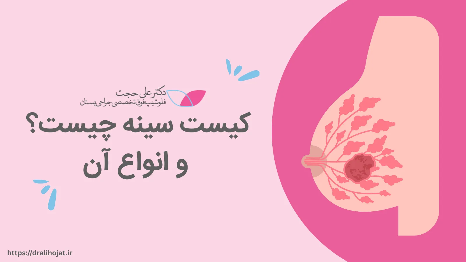 کیست پستان