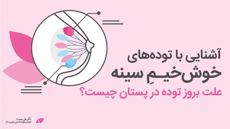 توده خوش خیم سینه و درمان آن